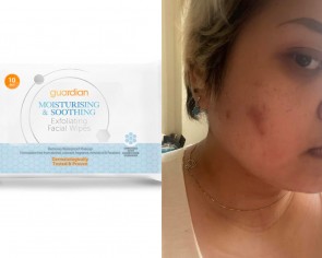 &#039;Bloodstain on my pillow&#039;: Woman on being scarred after using facial wipes from pharmacy to clean pimples