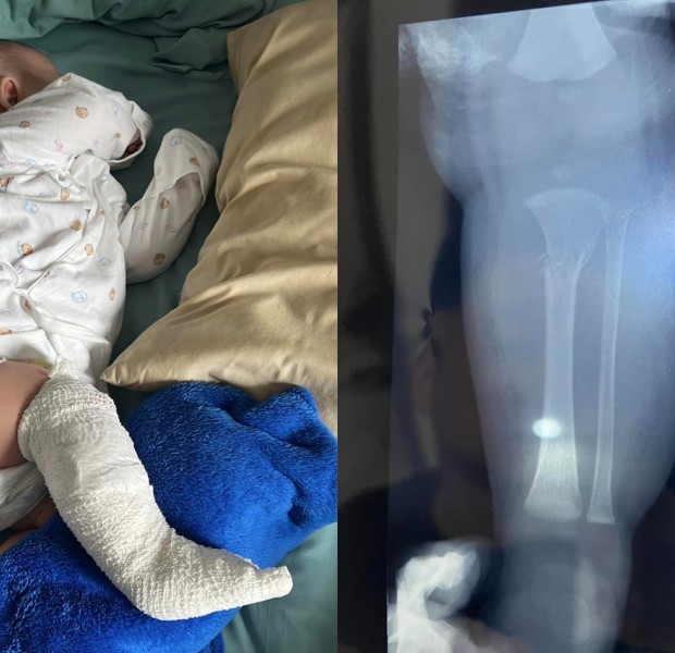 Mum finds baby&#039;s leg broken after just two weeks with babysitter in Malaysia