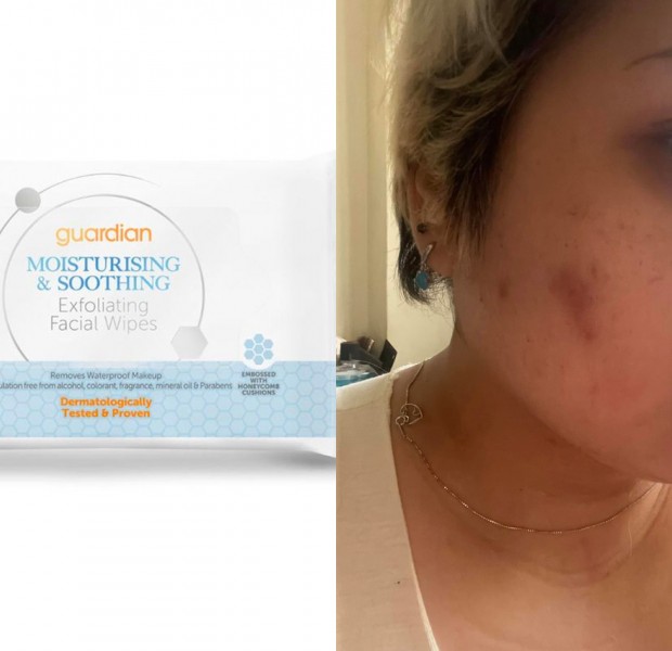 &#039;Bloodstain on my pillow&#039;: Woman on being scarred after using facial wipes from pharmacy to clean pimples